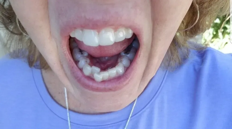 overlapping teeth