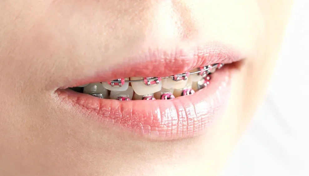 braces-bigger-lips