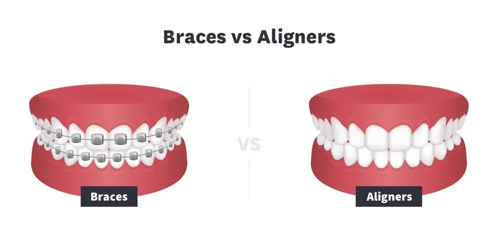 Braces vs Aligners