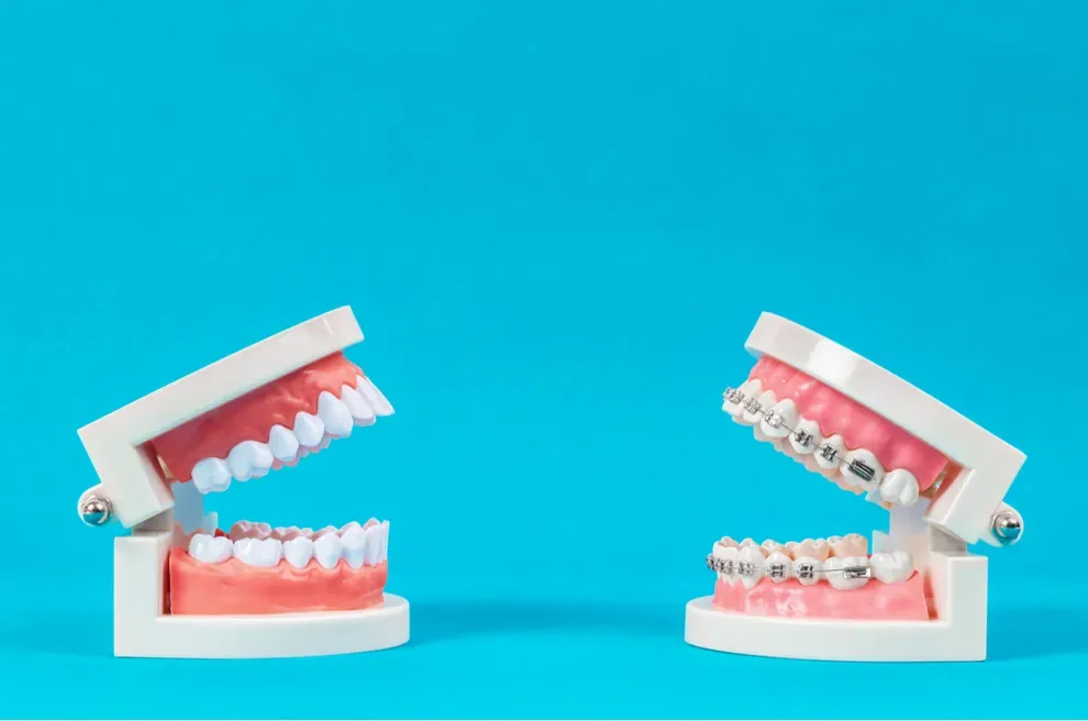 braces-vs-aligners