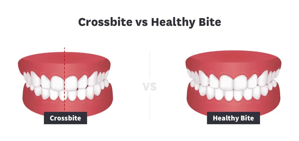 Crossbite vs Healthy Bite
