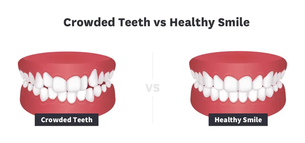 Crowded Teeth