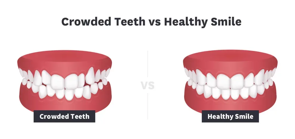 crowded teeth vs healthy smile