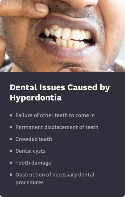 Dental Issues Caused by Hyperdontia