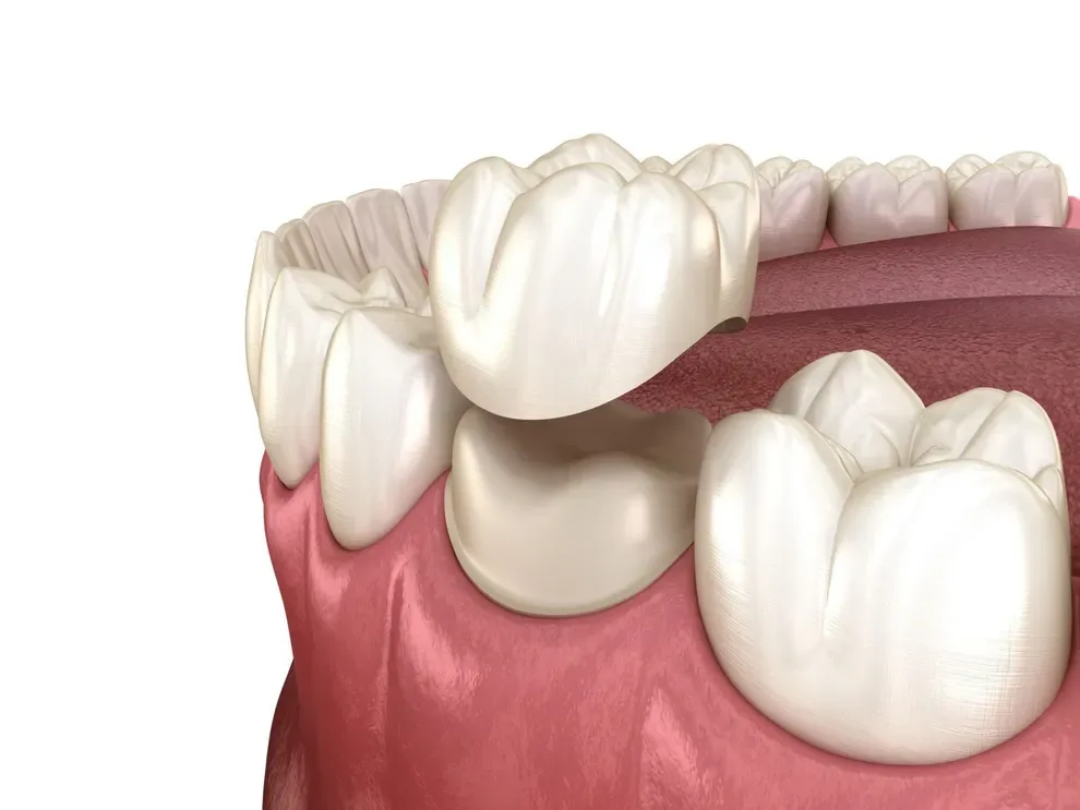 dental-restoration