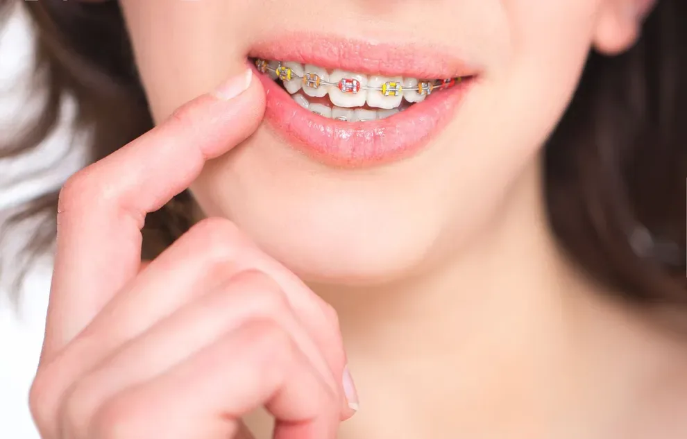 does-medicaid-cover-braces