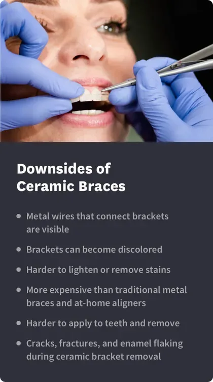 Downsides of Ceramic Braces
