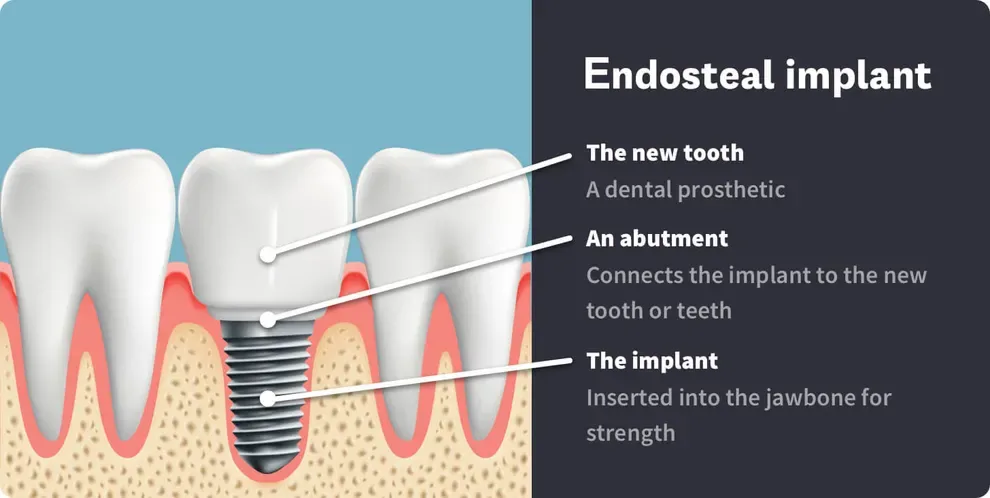 endosteal implant