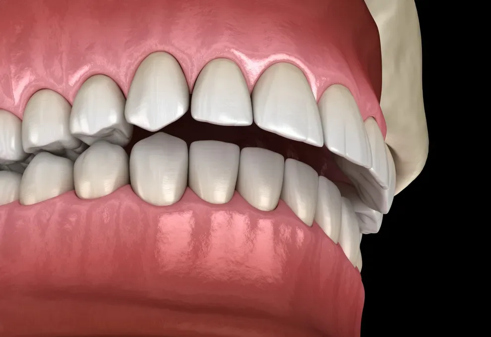 fix-an-overbite