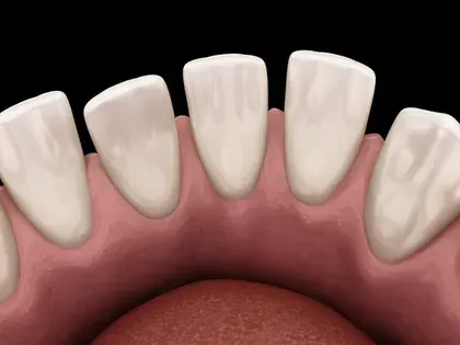 gaps in teeth