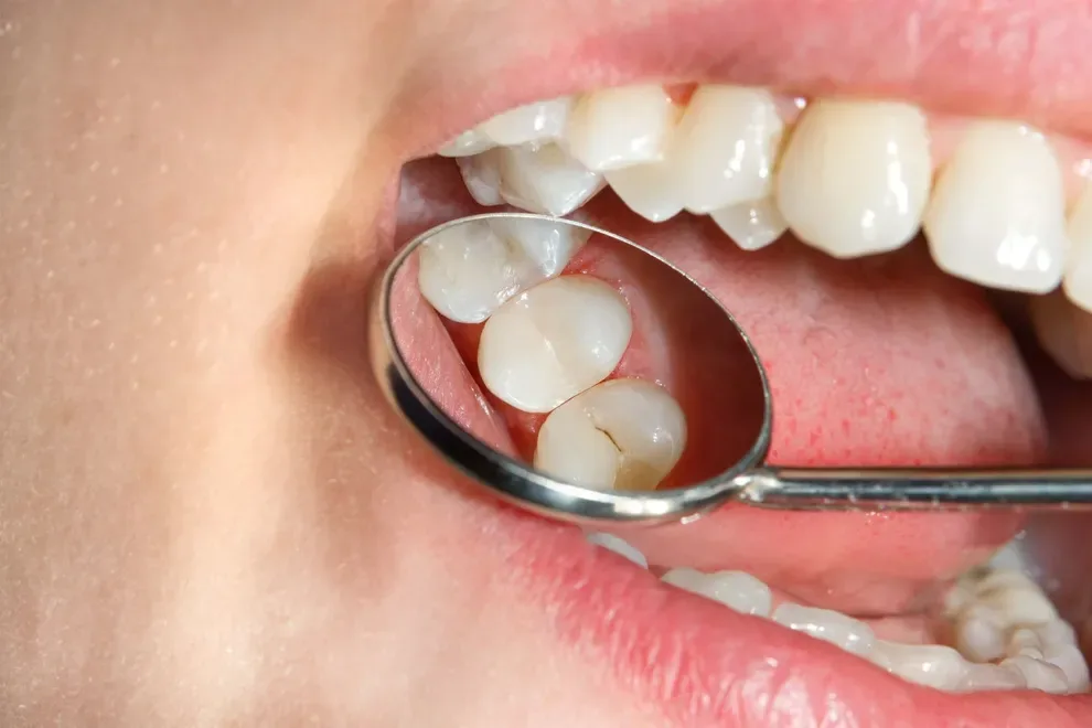 guide-to-cavities