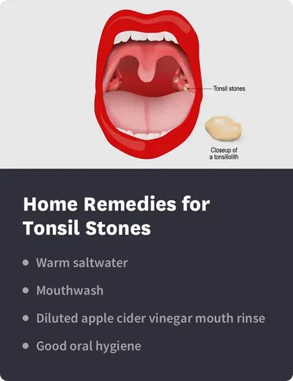 home remedies for tonsil stones