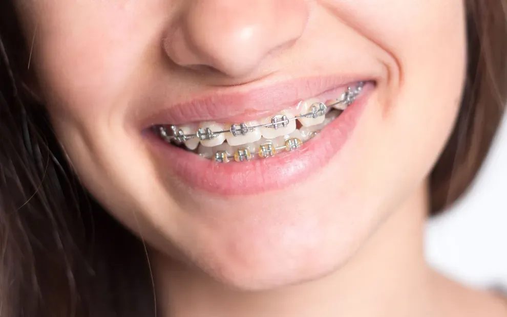 how-braces-stain-teeth-non-staining-alternatives