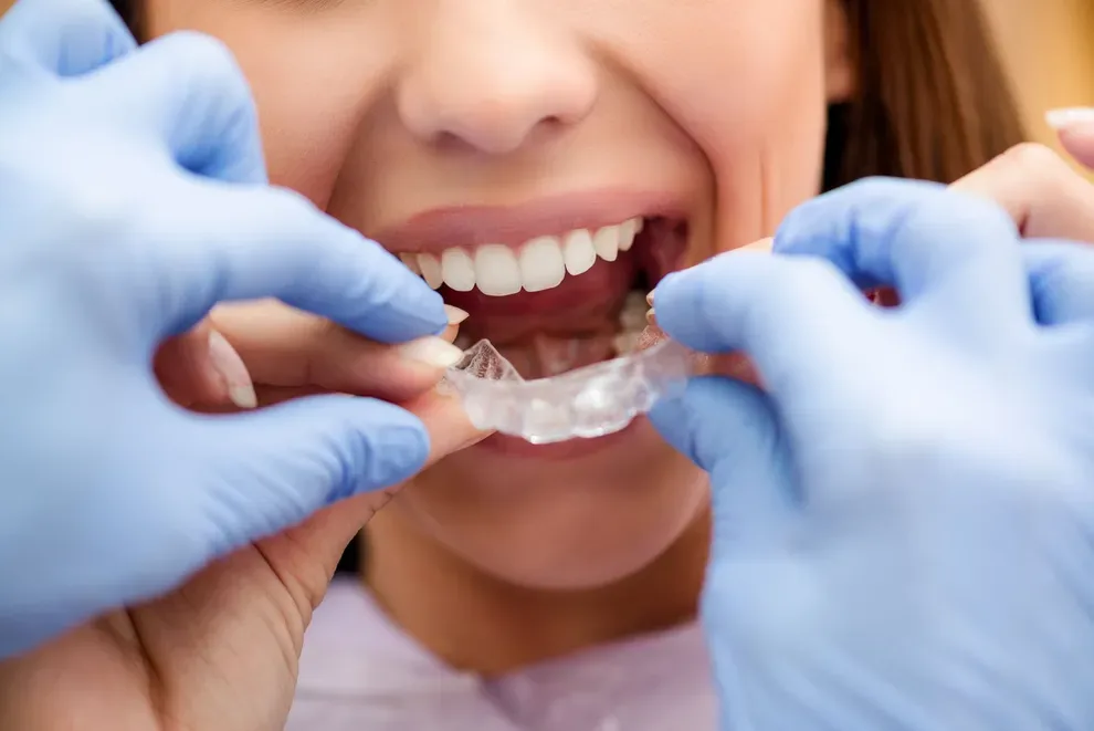 how-to-fix-an-overbite