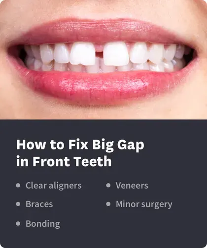 How to Fix Big Gap in Front Teeth