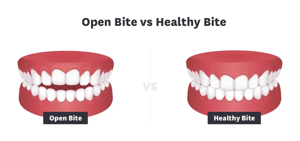 Open Bite vs Healthy Bite