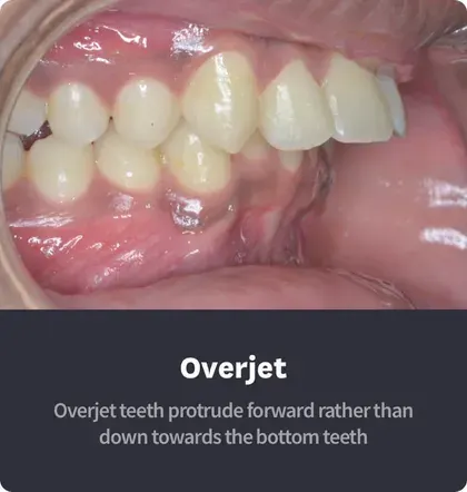 Overjet Teeth Example