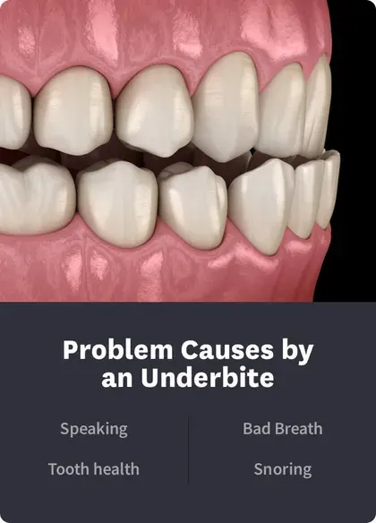 Problems Caused by an Underbite