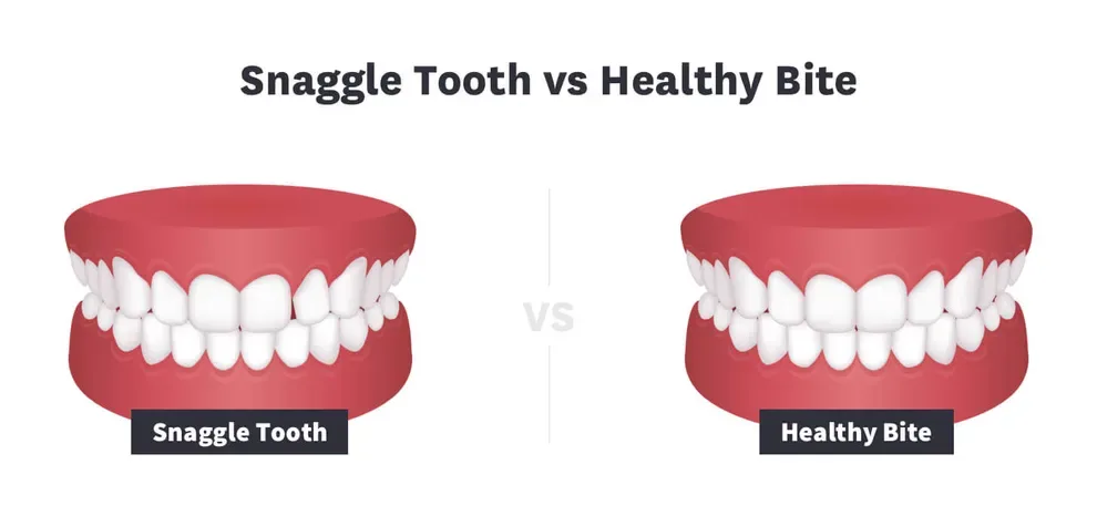 snaggle tooth vs a healthy bite