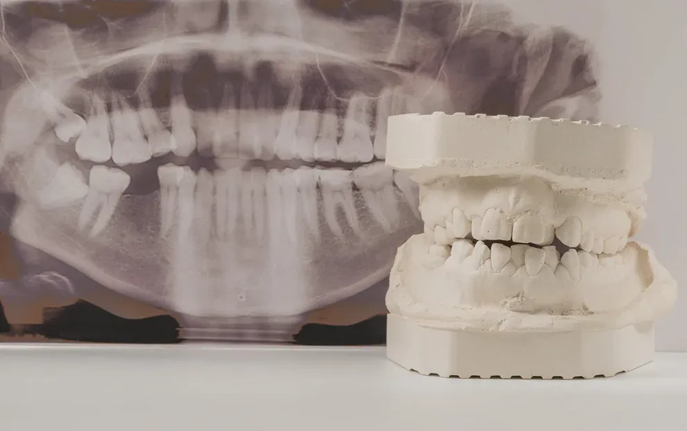 teeth-x-rays