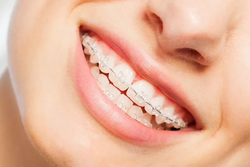 traditional-braces