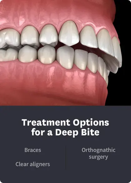 Treatment Options Deep Bite
