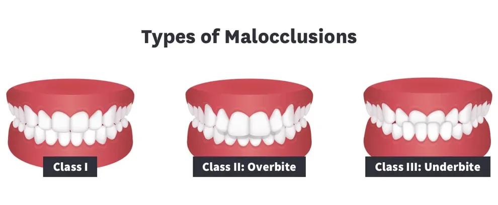 types of malocclusions