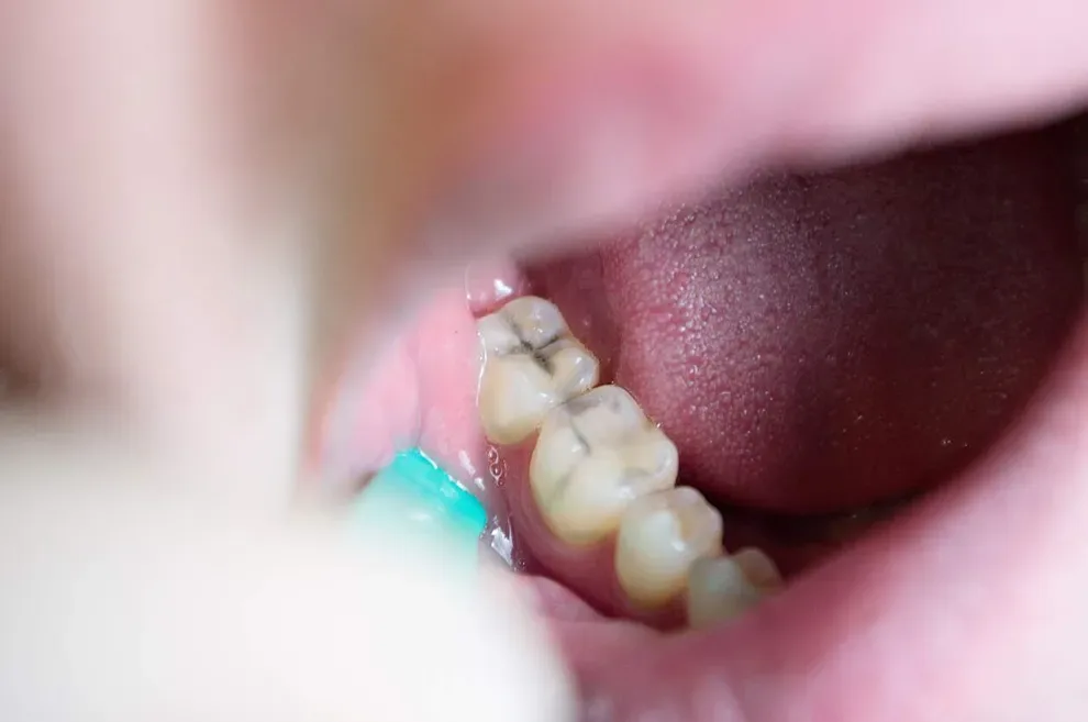 why-filling-cavities-at-home-doesn-t-work