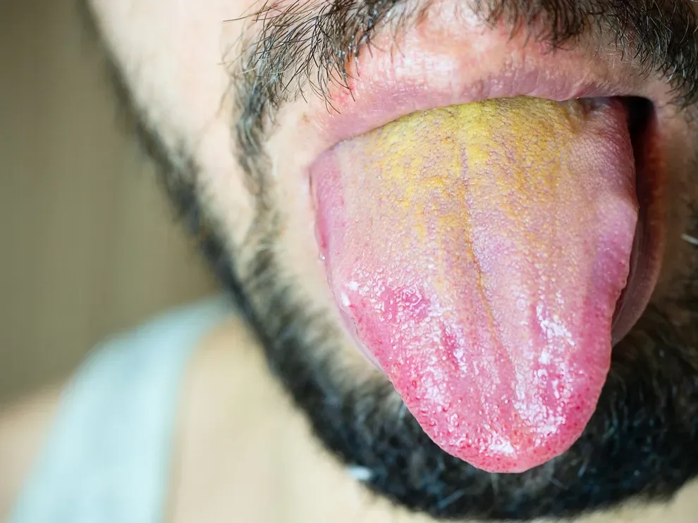 why-is-my-tongue-yellow