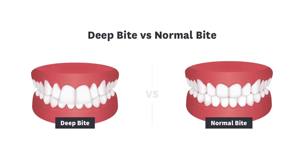 deep bite vs normal bite