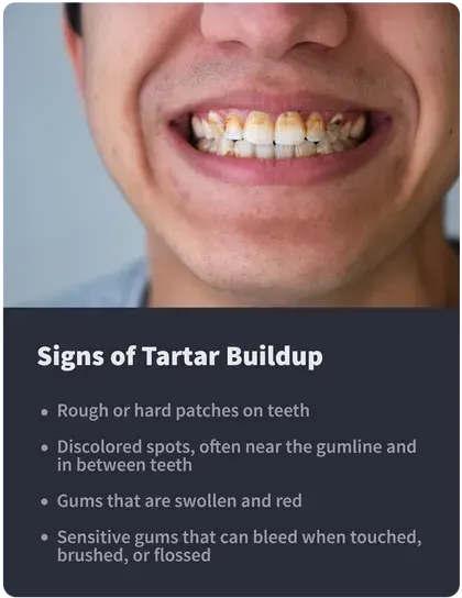 Signs of Tartar Buildup